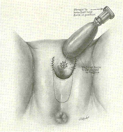 428px x 460px - Transsexual Sex Reassignment Surgery (male to female)